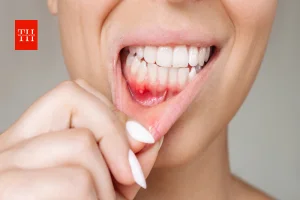 Health News: मसूड़ों से बार-बार खून आना सिर्फ दांत की समस्या नहीं, हो सकता है डायबिटीज का संकेत
